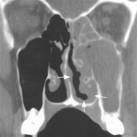 Computed Tomographic Findings In Patients With Invasive Fungal