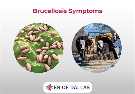 Brucellosis: Causes, Symptoms, and Treatment Options - ER of Dallas