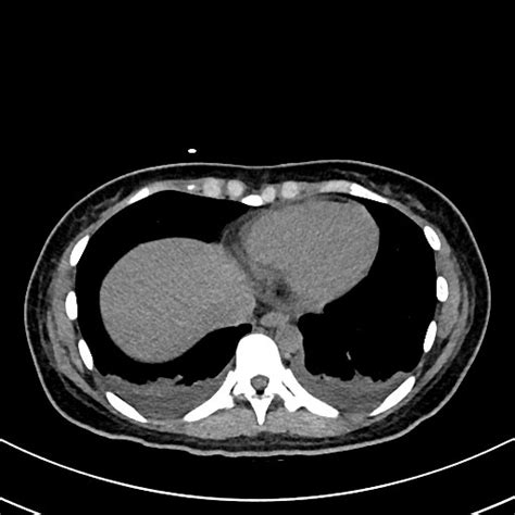 Choledocholithiasis And Choledochal Cyst Radiopaedia 79452 92568 Axial Cholangiogram Nc Commons