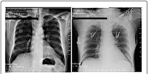 Concurrent Posterior Anterior Chest Radiography Showing Decreased