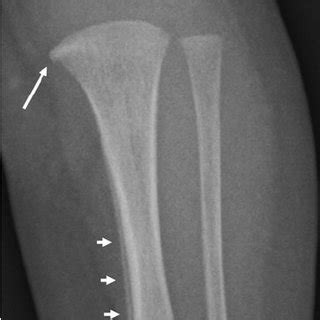 Series of radiographs indicates a classic metaphyseal fracture in an... | Download Scientific ...