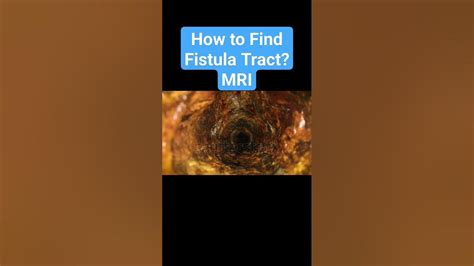 How To Find A Fistula Tract Mri Pelvic Region Is The Gold Standard