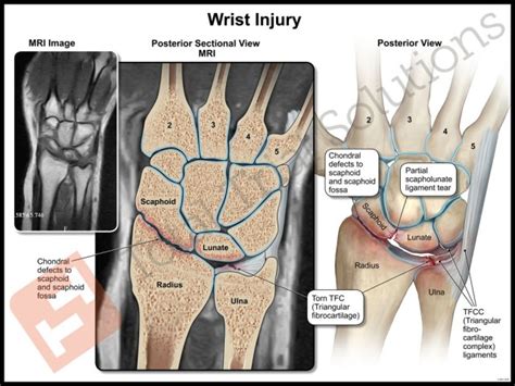 Medical Illustration Right Wrist Arthroscopic Surgeries Total Trial