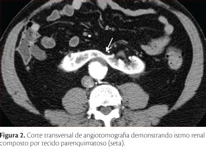 SciELO Brasil Tratamento Endovascular De Aneurisma De Aorta