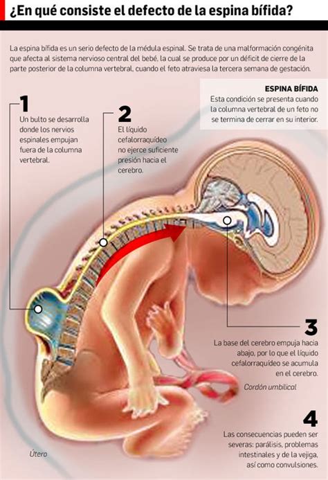 Espina Bífida Fisioonline