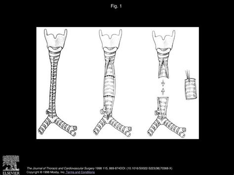 Repair Of Congenital Tracheal Stenosis With A Free Tracheal Autograft