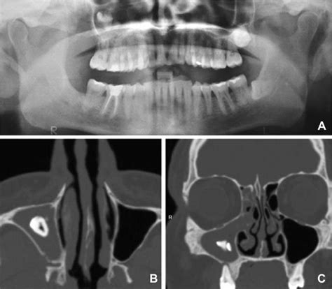 Panoramic Radiograph With The Third Molar Displaced Into The Maxillary Download Scientific