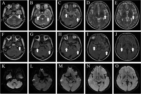 Frontiers Case Report Overlapping Anti Ampar Encephalitis With Anti Iglon5 Disease Post