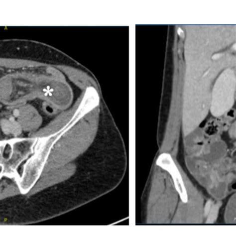 Laparoscopic View Of The Lead Point Of The Ileo Ileal