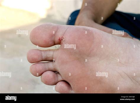 Tinea Pedis Fotografías E Imágenes De Alta Resolución Alamy