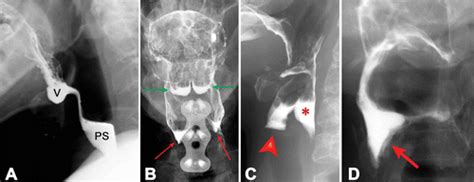 Vallecula And Pyriform Sinuses