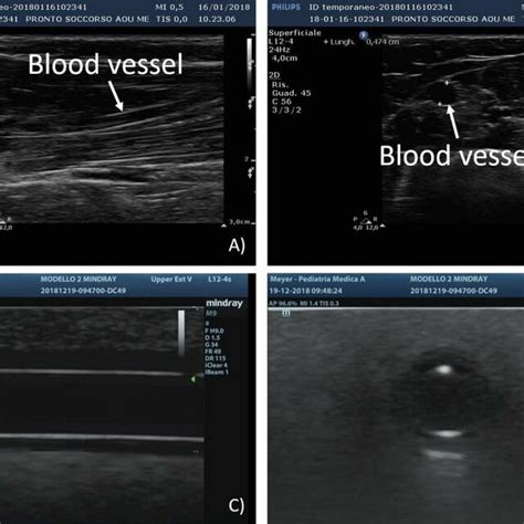 Ultrasound Images Comparison A Transverse Section Of Human Vessels Download Scientific