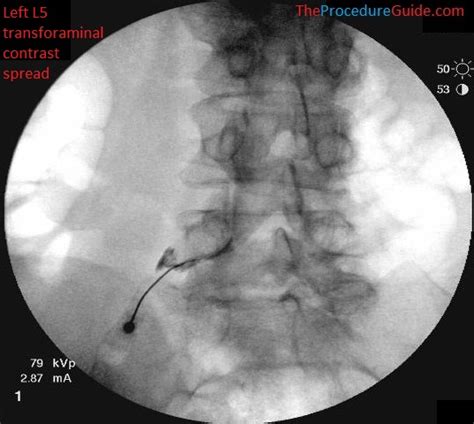 Fluoroscopic Guided Thoracic/Lumbar Transforaminal Epidural, 45% OFF