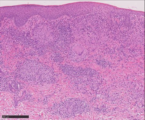 Network Of Cells In The Formation Of Sarcoidal Granuloma A Biopsied Download Scientific