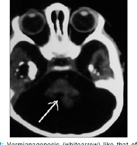 Figure 3 From Extensive Intracranial Calcification Of Pseudo Torch