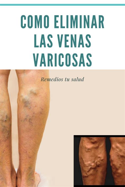 Como Eliminar Las Venas Varicosas En 2020 Venas Varicosas Salud