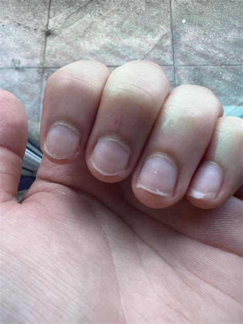 Does These Look Like Muehrckes Lines Rmedical