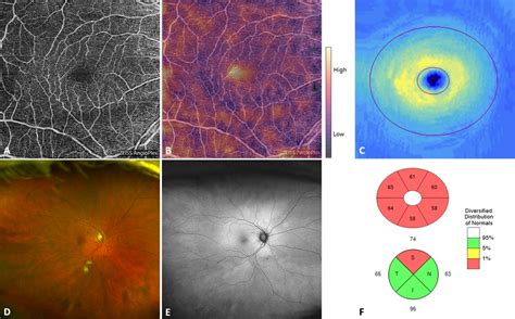 Convolutional Neural Network To Identify Symptomatic Alzheimers