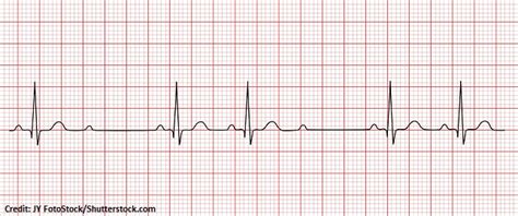 Second Degree Type Ii Heart Block Mobitz Ii Quiz Questions