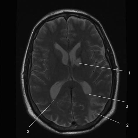 MRI slice from our patient showing a left basal ganglia haemorrhagic ...