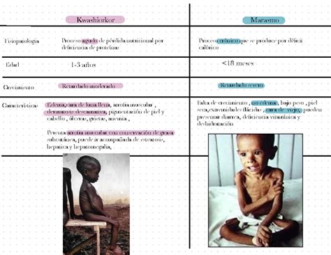 Pedía 2 Cuadro Comparativo Desnutrición Kwashiorkor Marasmo Fisiopatologia Proceso Agudo De