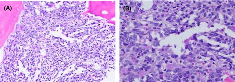 Bone Marrow Biopsy Section Shows 5 10 Residual Blasts After Induction Download Scientific