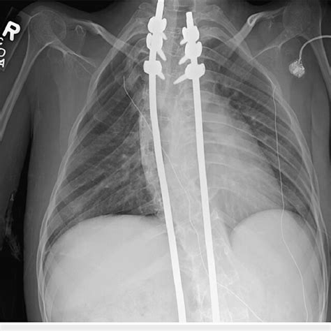 Last Chest Radiograph Performed Showing Almost Complete Resolution Of