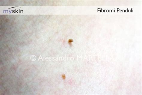 Cosa c è da sapere sui fibromi penduli Myskin