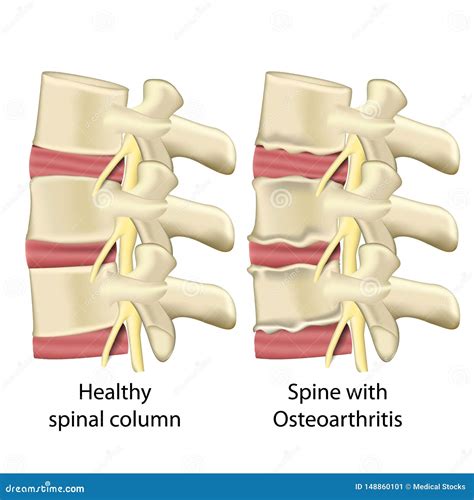 Albums 91 Images Pictures Of Arthritis In The Spine Excellent