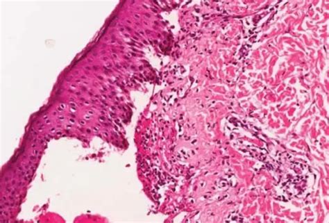 What are Bullous Diseases? – Pathosomes