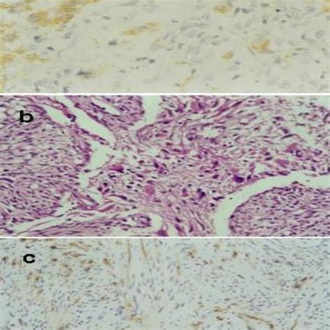 Photomicrographs Of The Tumor A The Gliomatous Component Gfap