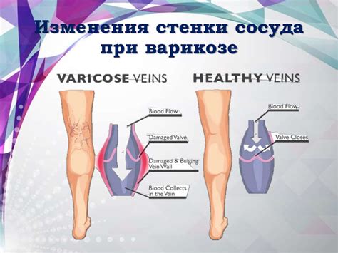 Трофические язвы голени - презентация онлайн