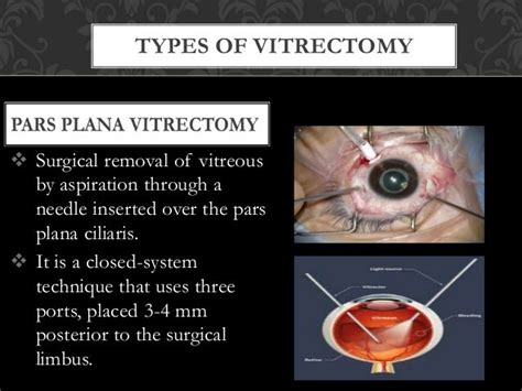 Types Of Vitrectomy Indication S And Complications