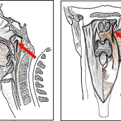 (PDF) Endonasal approach of salpingopharyngeus muscle for the treatment ...