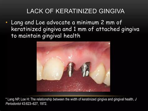 Periimplantitis | PPTX