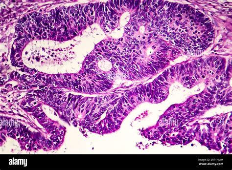 Ad Nocarcinome Intestinal Diff Renci Micrographe L Ger Photo Sous