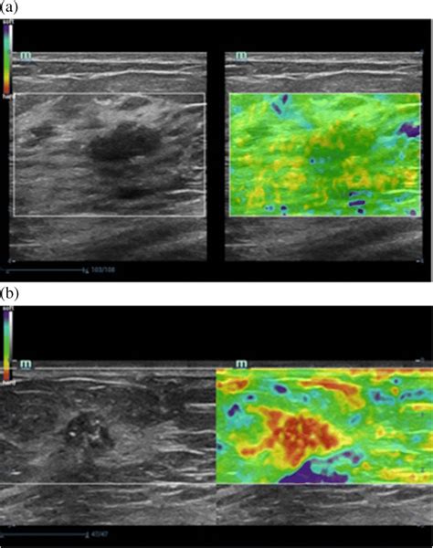 Examples Of Breast BUS Left And EUS Right Images In The Breast