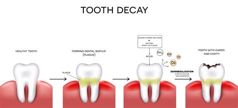 Dental Filling Sunshine Dental