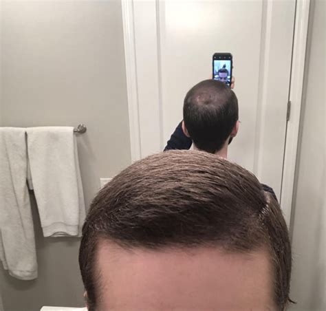 4 Month Finasteride And 3 Month Minoxidil Results R Tressless