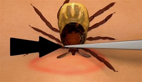 How to remove ticks efficiently and safely - ONEjive.com