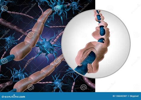 Multiple Sclerosis Myelin Disease Stock Illustration Illustration Of