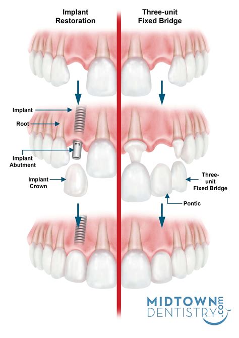 Hybrid Denture And Dental Implant Bridge Explained Dental Implant