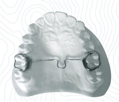 Transpalatal Arch Ortho Appliance Tpa Orthodontics