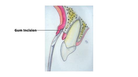 Apicoectomy: The Tooth-Saving Procedure You Need to Know About