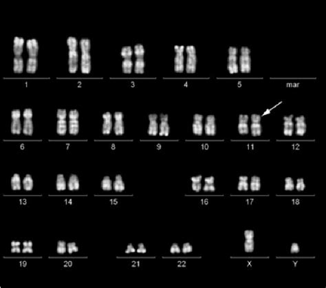 Jacobsen Syndrome Karyotype Hot Sex Picture