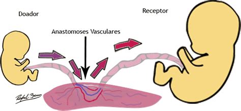 S Ndrome Da Transfus O Feto Fetal Fetalmed