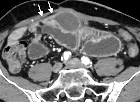 Adhesive Small Bowel Obstruction Predictive Radiology To Improve