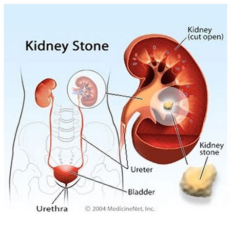 KIdney Stones — Santa Rosa Nephrology Associates