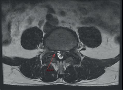 Preoperative magnetic resonance imaging (MRI) scan. This axial... | Download Scientific Diagram