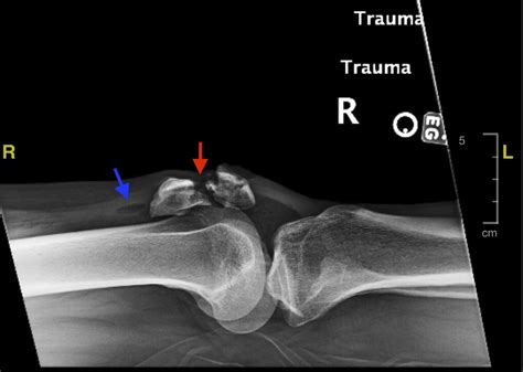 Longitudinal Patella Fracture